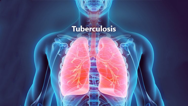 টি বি রোগ | Tuberculosis (TB)