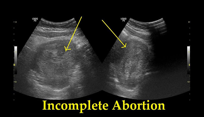 ইনকম্প্লিট এবর্শন | Incomplete Abortion